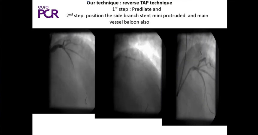 Interventional cardiologist Ioannis Tsiafoutis - Reverse TAP - A new modification of bifurcation technique